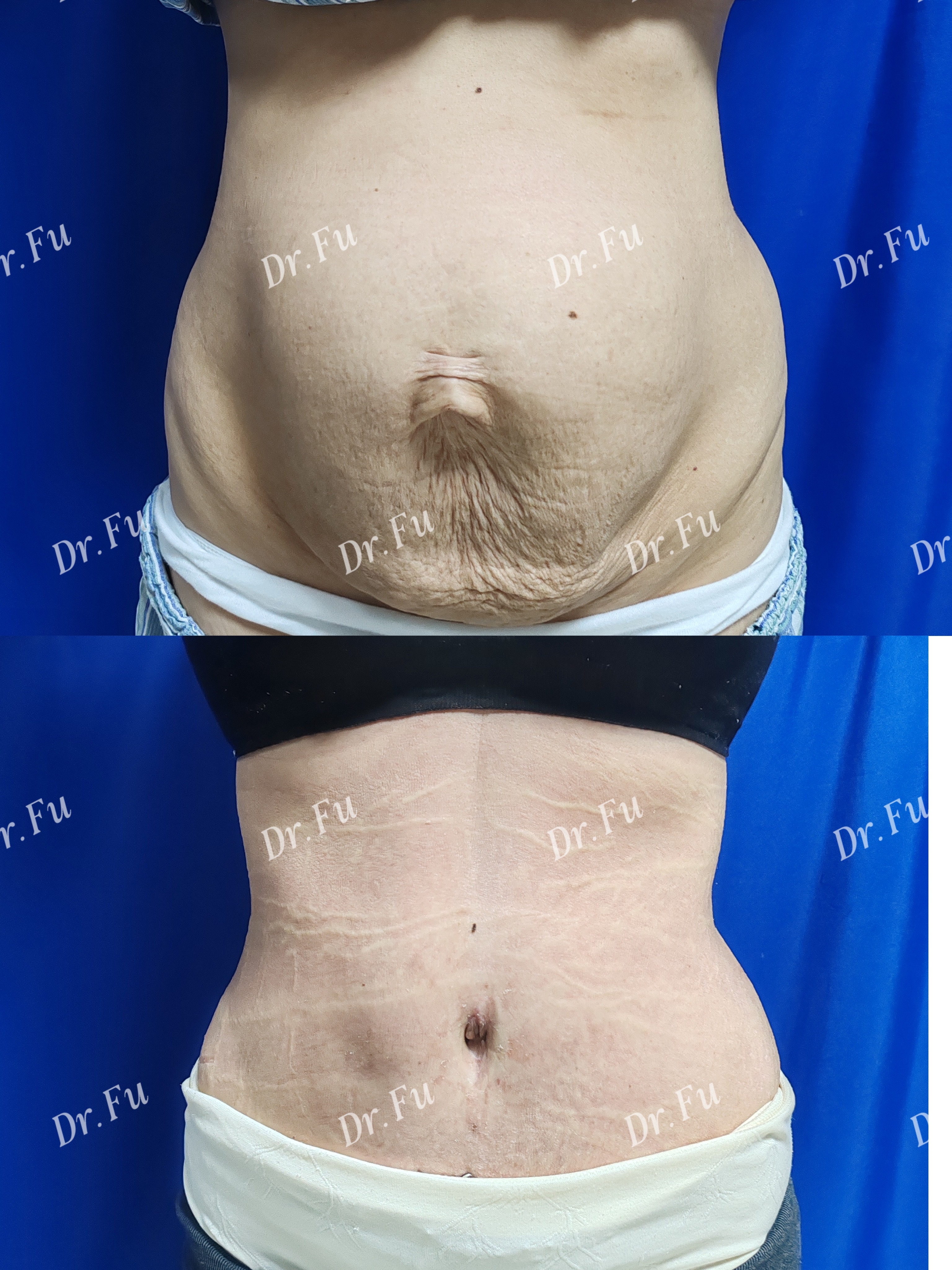 Abdominoplasty Case 7